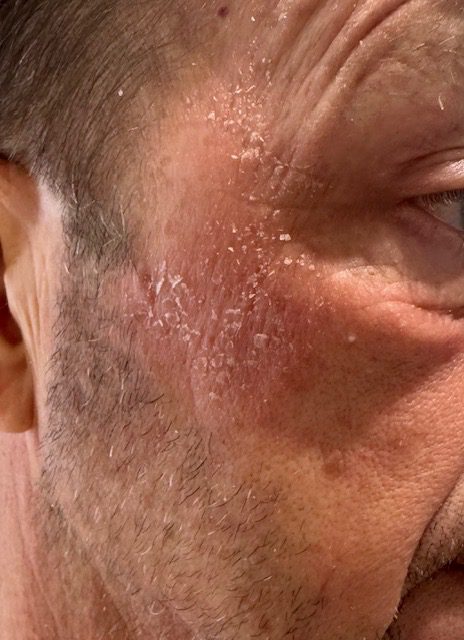 Skin before using NX1 Face Balm